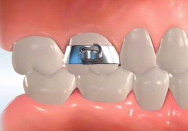 Banding braces clearance