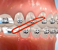 braces brackets without rubber bands